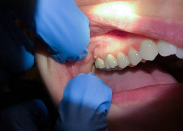 Best Emergency Wisdom Teeth Removal in Uhland, TX